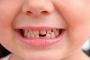 Необходима ли реставрация передних временных зубов у детей?