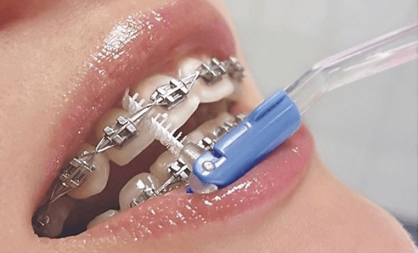 Как чистить брекеты электрической зубной щеткой ингалятор электро